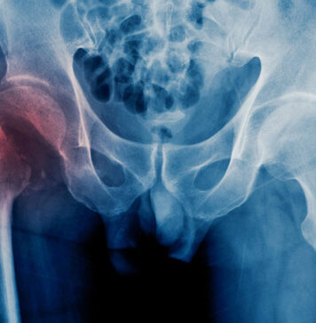 Lifestyle Fallout From Hip Fracture Declines by Year 2 | Nutrition Fit