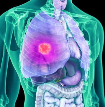 Many ED Visits May Be Preventable for Patients With NSCLC | Nutrition Fit