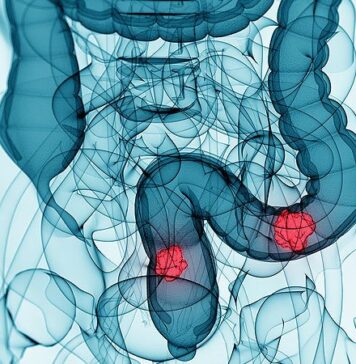 Triplet Shows ‘Promising’ Activity in Unresectable/Metastatic CRC | Nutrition Fit