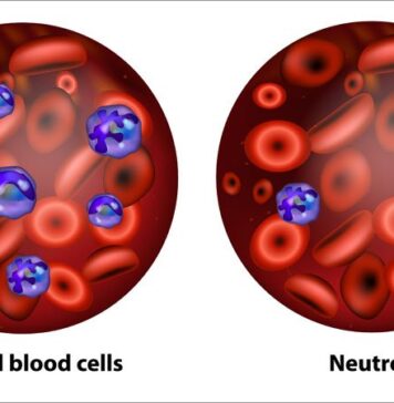 ‘Major Advancement’ in Preventing Neutropenia, Says Trialist | Nutrition Fit