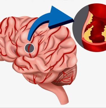 One in Five TIA Patients Go on to Stroke, Even in Current Era | Nutrition Fit