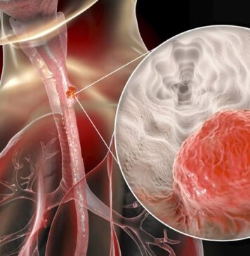 Higher Intensity Therapy and Surgical Risk in Esophageal Cancer | Nutrition Fit