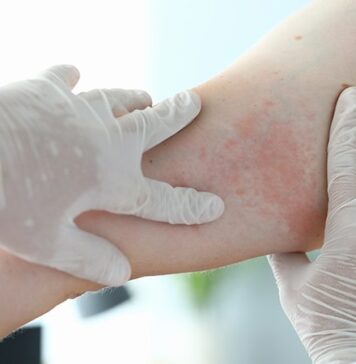 Expert Highlights Advances in DRESS | Nutrition Fit