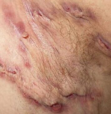 Oral JAK1 Inhibitor Shows Promise for Hidradenitis Suppurativa | Nutrition Fit