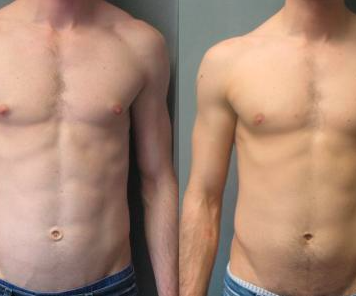 Bodybuilder Puffy Nipples