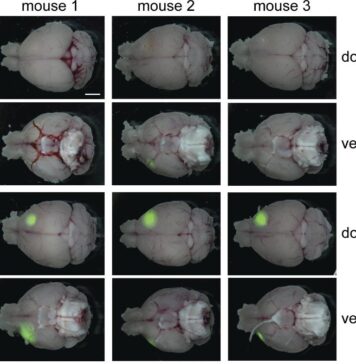 Study Links Cellular Transport Pathway to Aggressive Brain Cancer | Nutrition Fit
