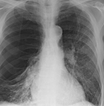 New COPD Mortality Risk Model Includes Imaging-Derived Variables | Nutrition Fit