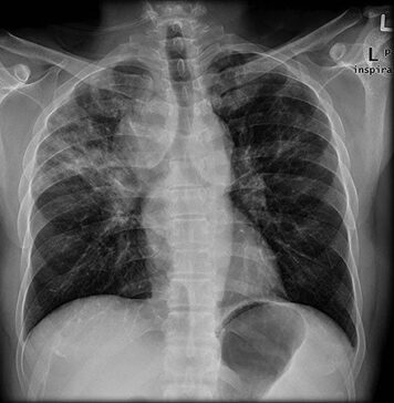 Lung Disease Raises Mortality Risk in Older RA Patients | Nutrition Fit