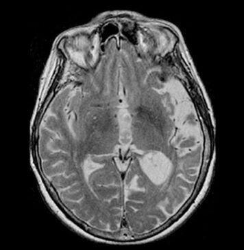 Type of Alzheimer’s With Intact Memory Offers New Research Paths | Nutrition Fit