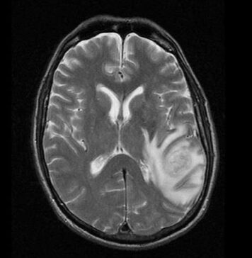 Unexpectedly, Immunotherapy Response Linked to Low TMB in rGMB | Nutrition Fit
