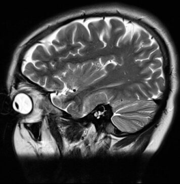 Idiopathic Intracranial Hypertension on the Rise | Nutrition Fit