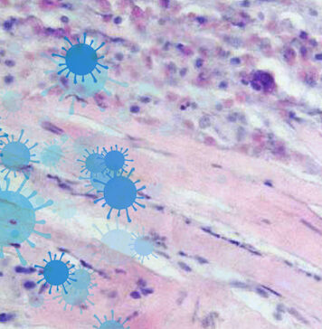 Review Shows Little Risk for Myocarditis in COVID-19 | Nutrition Fit