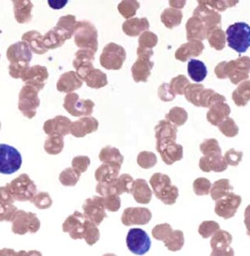 Ibrutinib ‘Treatment of Choice’ in Waldenstrom Macroglobulinemia | Nutrition Fit