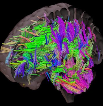 Obesity May Exacerbate the Effects of Alzheimer’s Disease | Nutrition Fit