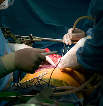 Does Surgery for Colorectal Liver Metastases Release Tumor Cells? | Nutrition Fit
