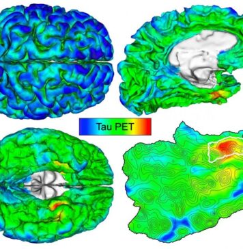 Automated Imaging Detects and Tracks Brain Protein Involved in Alzheimer’s Disease | Nutrition Fit