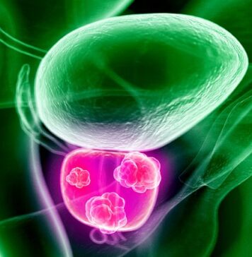 Combo Disappoints in Metastatic Prostate Cancer | Nutrition Fit