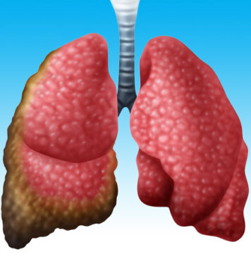 Nivolumab Improves Survival in Relapsed Mesothelioma | Nutrition Fit