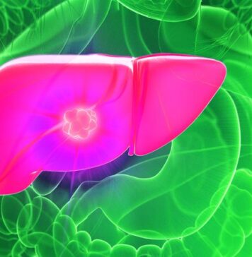 TACE Plus Sorafenib Improves PFS in Unresectable HCC | Nutrition Fit