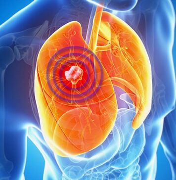 ‘Astonishing’ 4-Year Survival in NSCLC With Pembro+Chemo | Nutrition Fit