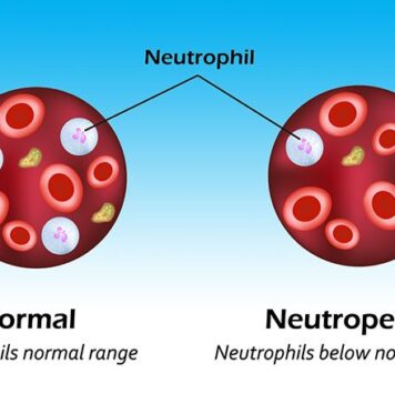 Convenience, Cost Sway Choice of G-CSF Added to Chemo | Nutrition Fit
