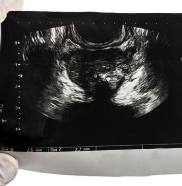 MRI-Guided Prostate Biopsy Prevails in PRECISE Trial | Nutrition Fit