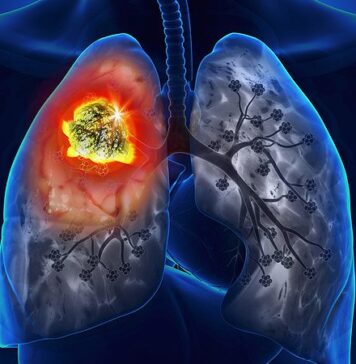 ‘Unprecedented’ Long-term Survival After IO in Pretreated NSCLC | Nutrition Fit