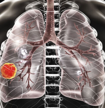 Customized Chemotherapy Did Not Improve Survival in Early NSCLC | Nutrition Fit