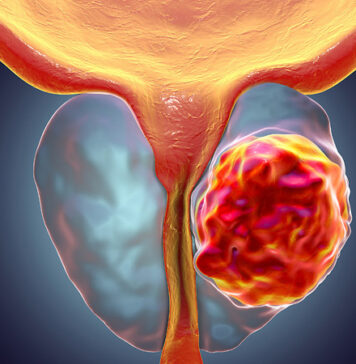 Androgen Annihilation Strategy Prolongs rPFS in mCRPC | Nutrition Fit