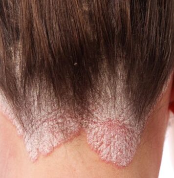 Psoriasis Registry Study Finds Normal Pregnancy Outcomes | Nutrition Fit