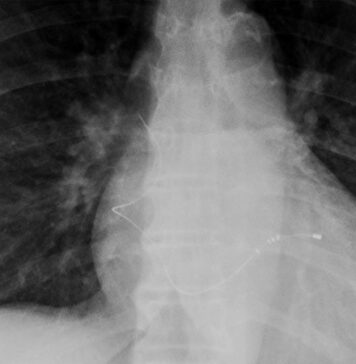 Abandoned Cardiac Device Leads Don’t Rule Out MRI | Nutrition Fit