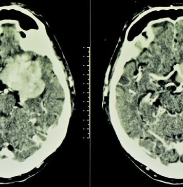Increased Risk of Meningioma With Cyproterone Acetate Use | Nutrition Fit