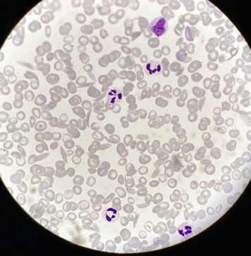 FDA Places Clinical Hold on Sickle Cell Gene Therapy | Nutrition Fit