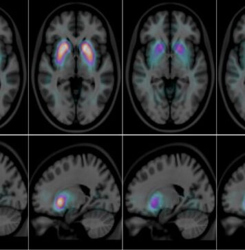 Imaging of a Living Brain Can Help Clearly Differentiate Between Two Types of Dementia | Nutrition Fit