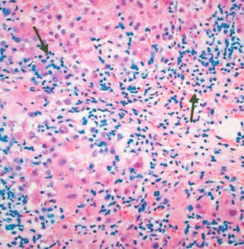 Incidence of Autoimmune Hepatitis May Be Rising | Nutrition Fit