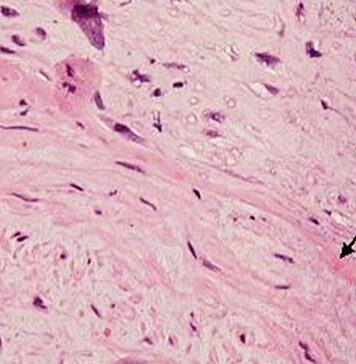 Did Unrecognized Cardiac Amyloidosis Hinder Recent HFpEF Trials? | Nutrition Fit