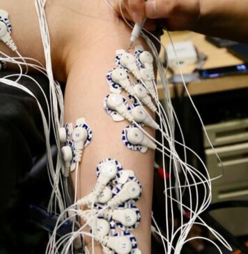 New Surgery May Enable Better Control of Prosthetic Limbs | Nutrition Fit