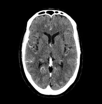 Enlarged Perivascular Spaces in the Brain Predict Dementia Risk | Nutrition Fit