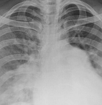Outcomes Have Improved for PAH in Connective Tissue Disease | Nutrition Fit