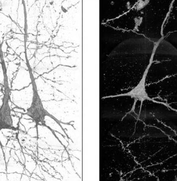 Seeing Schizophrenia: X-Rays Shed Light on Neural Differences | Nutrition Fit