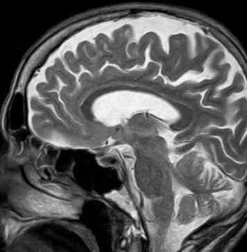 Target for Stroke Therapy in Blood-Brain Barrier Discovered | Nutrition Fit