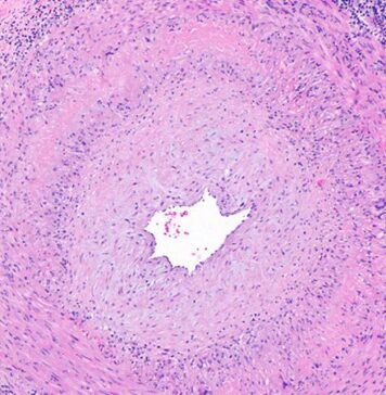 Frozen Sections Can Guide Biopsies for Giant Cell Arteritis | Nutrition Fit