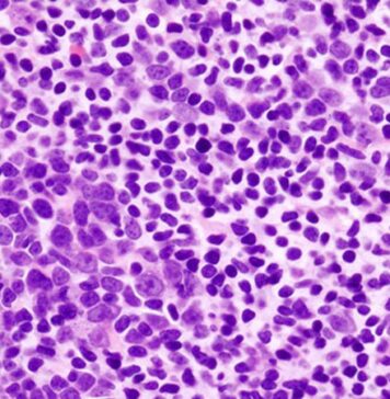 FDA OKs New CAR T- Cell Tx for Large B-cell Lymphomas | Nutrition Fit