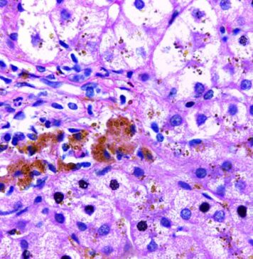 Common Genetic Disorder Tied to Increased Dementia Risk in Men | Nutrition Fit