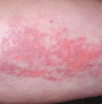 Home Subcutaneous Immune Globulin for Refractory Dermatomyositis | Nutrition Fit