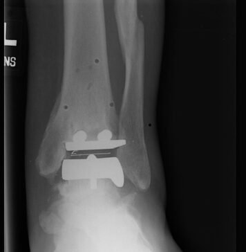 STAR Ankle Implants Could Break | Nutrition Fit
