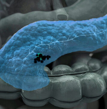 Ablative Radiation Extends Life in Unresectable Pancreatic Cancer | Nutrition Fit