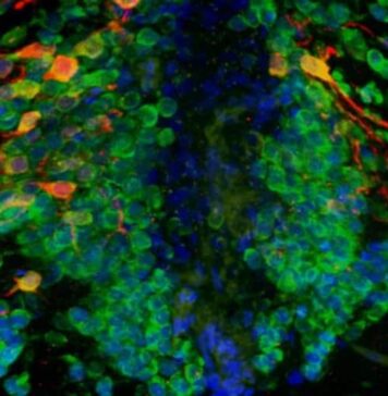 Parkinson’s Gene May Impair How New Neurons Are Made Throughout Our Lifetime | Nutrition Fit