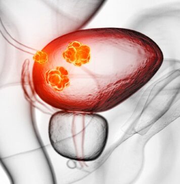 Enfortumab Vedotin Shows Promise for Urothelial Carcinoma | Nutrition Fit