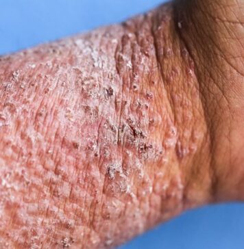 Severe Atopic Dermatitis Often Puts a Dent in Quality of Life | Nutrition Fit